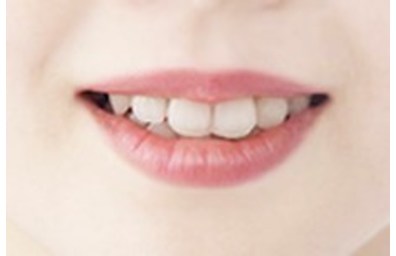 ホワイトニング