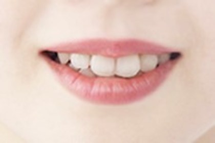 ホワイトニング